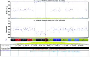 This plot of genetic data from an individual with autism shows a deletion in the gene NCAM2, one of four genes that researchers in the Simons Center for Systems Biology found to be associated with autism.