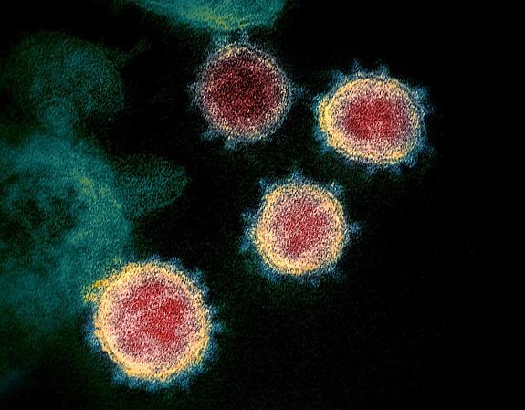 Transmission electron micrograph of SARS-CoV-2 virions with visible coronae.